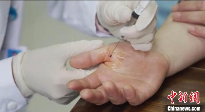 嘉善群眾體驗小針刀?！〖紊平y(tǒng)戰(zhàn) 供圖