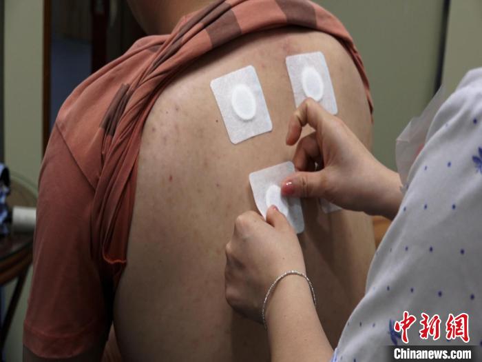 圖為醫(yī)生正在為民眾貼“三伏貼”?！√莆登?攝